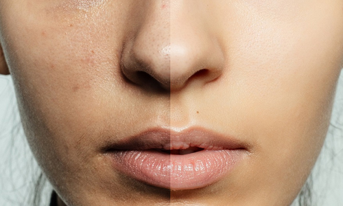 How to get rid of pigmentation?